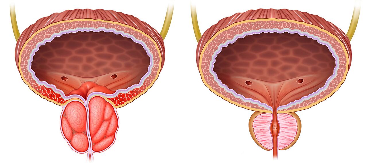 Prostate enflammée et saine après avoir utilisé des capsules pré-stonorm