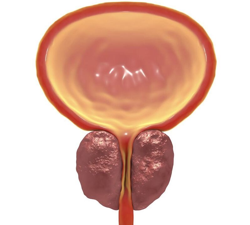 Inflammation de la prostatite chronique