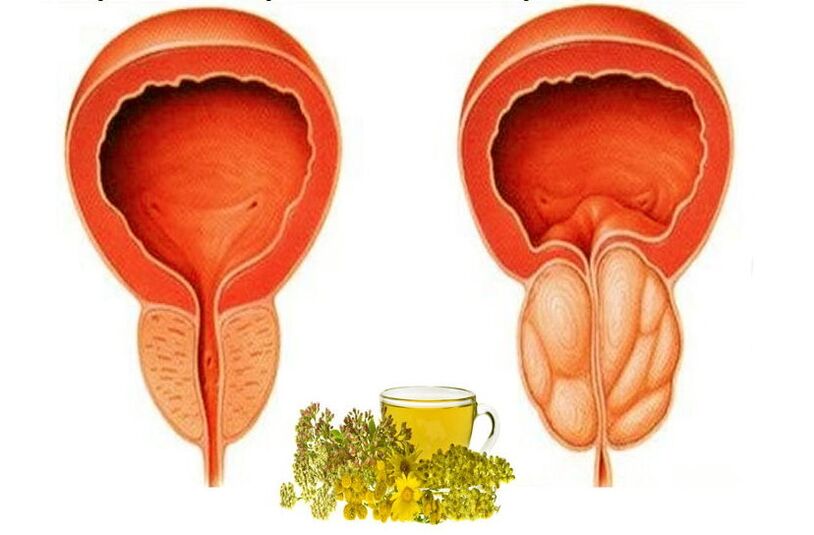 Prostate saine et douloureuse