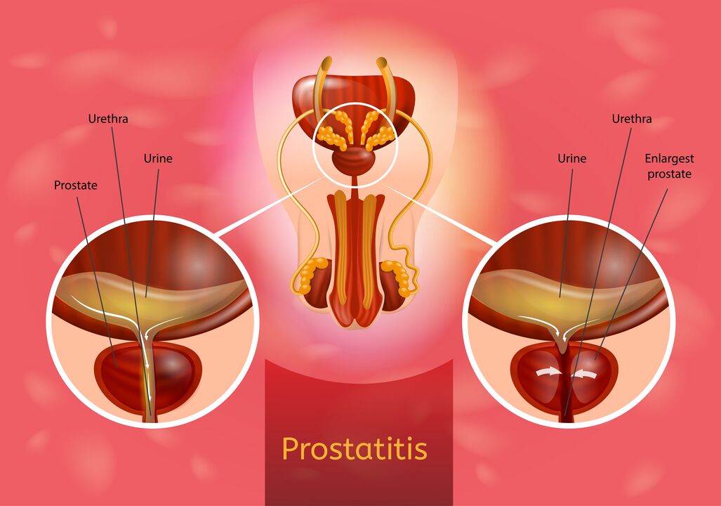 Prostate